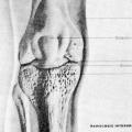Rheumatoid Arthritis, mailing piece